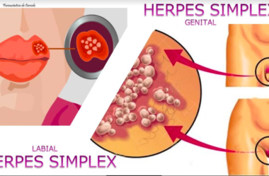 Herpes labial X herpes genital – Diferenças